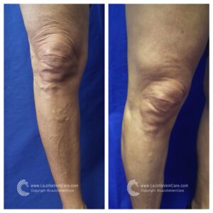 varicose vein treatment