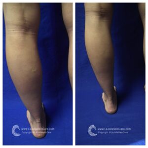varicose vein treatment