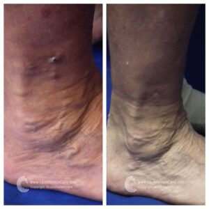 varicose vein treatment