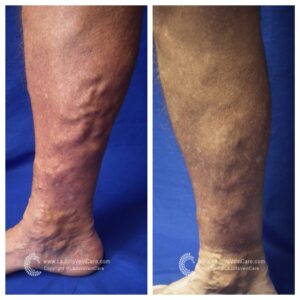 varicose vein treatment