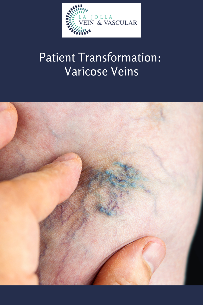 5 varicose vein treatment