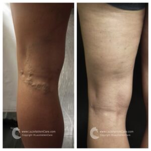 varicose vein treatment