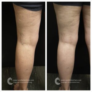 varicose vein treatment