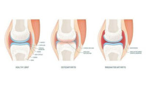 knee pain