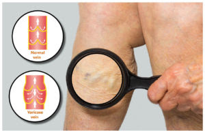 varicose veins