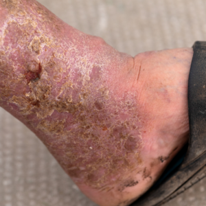 ulcers