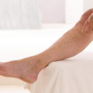 vein disease