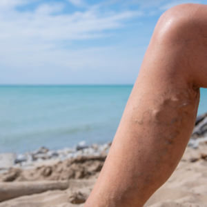 vein disease