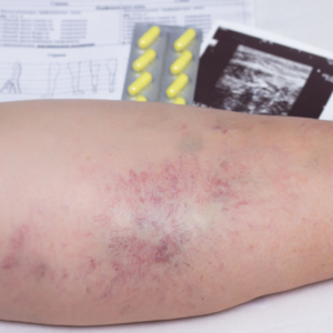 varicose vein