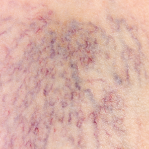 vein disease