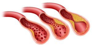 PAD progression blood vessels