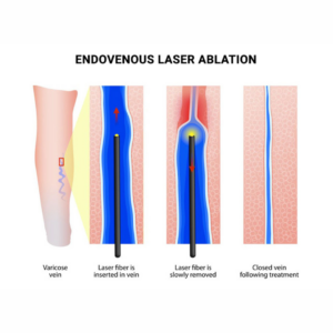 laser