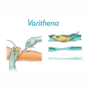 Chemical Ablation | Chemical Solutions for Vascular Wellness