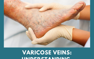 varicose