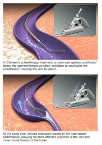 ClariVein Treatment: Minimally Invasive Solution for Leg Vein Health