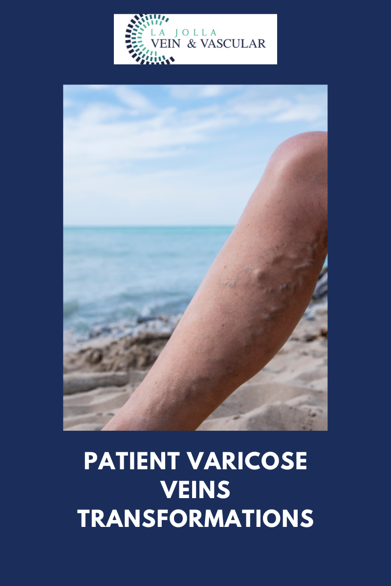 oc2blog varicose