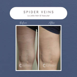 Patient Spider Veins Transformations - La Jolla Vein & Vascular