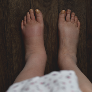Swelling Unveiled: Lymphedema Causes, Symptoms & Management
