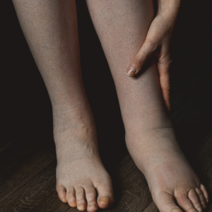 Swelling Unveiled: Lymphedema Causes, Symptoms & Management