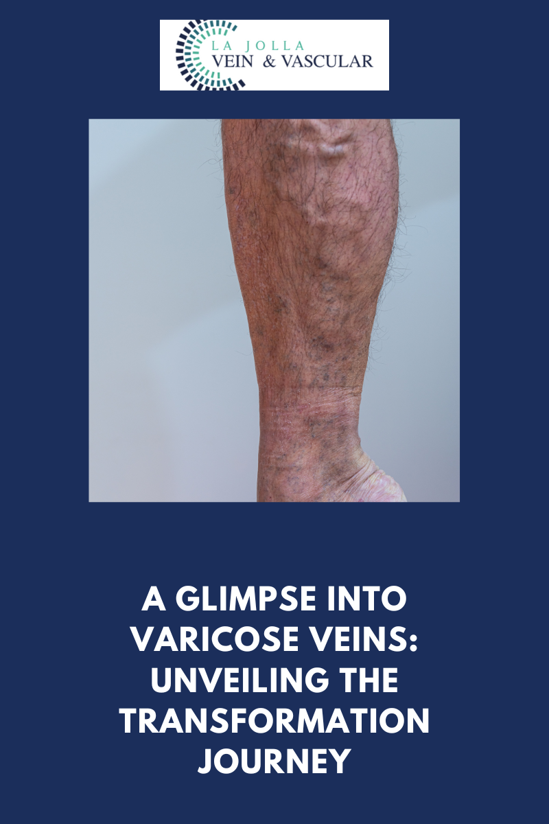 Dec1 varicose