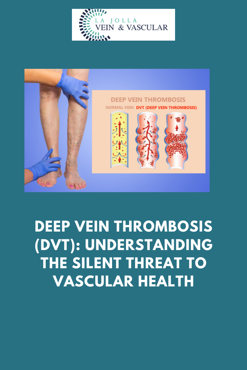dec18 Deep Vein Thrombosis (DVT) - Silent Threat to Vascular Health