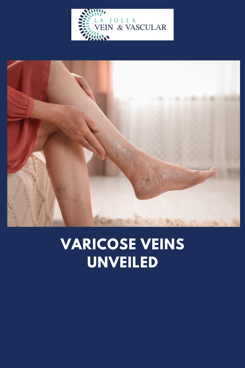 dec28 Varicose Veins 101: Causes, Symptoms & Relief Options