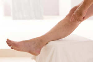 Uncovering Leg Pain: Is Venous Disease the Hidden Cause?