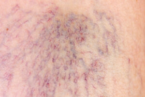 Spider Veins: Unmasking Causes, Solutions & Self Confidence