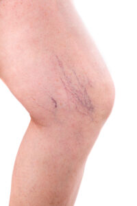 Spider Veins: Unmasking Causes, Solutions & Self Confidence