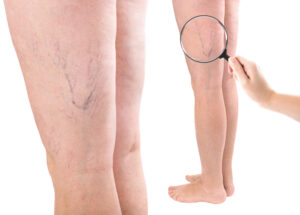 Crawling Up Your Legs: Understanding Spider Veins in & Out