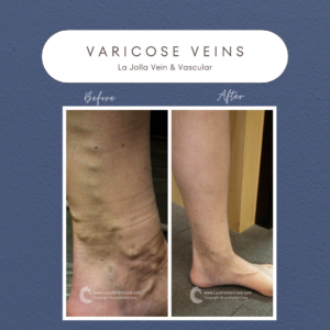 Success Stories in Varicose Vein Treatment at La Jolla