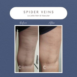 Spider Veins: Causes, Symptoms, and Effective Solutions