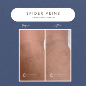 Spider Veins: Causes, Symptoms, and Effective Solutions