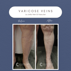 Varicose Vein Transformation: Before and After