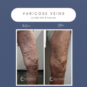 Success Stories in Varicose Vein Treatment at La Jolla