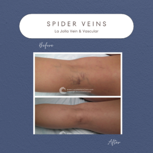 Radiant & Confident: Patient Transformations from Spider Veins