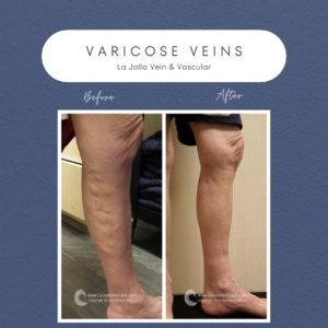 Varicose Vein Transformation: Before and After