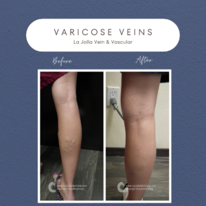 Success Stories in Varicose Vein Treatment at La Jolla