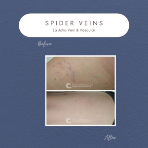 Radiant & Confident: Patient Transformations from Spider Veins