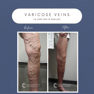 Success Stories in Varicose Vein Treatment at La Jolla