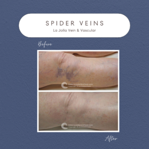 Radiant & Confident: Patient Transformations from Spider Veins