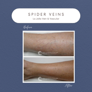 Radiant & Confident: Patient Transformations from Spider Veins