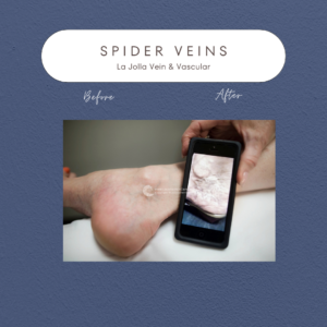 Spider Veins: Causes, Symptoms, and Effective Solutions