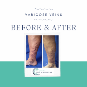 Visual Proof: Varicose Veins Treatment Patient Transformations