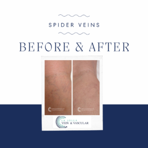 What Will My Legs Look Like After Spider Vein Removal?