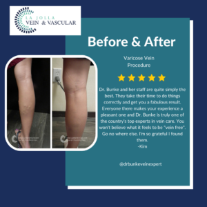 Patient Success Stories - The Best Vein Clinic in San Diego