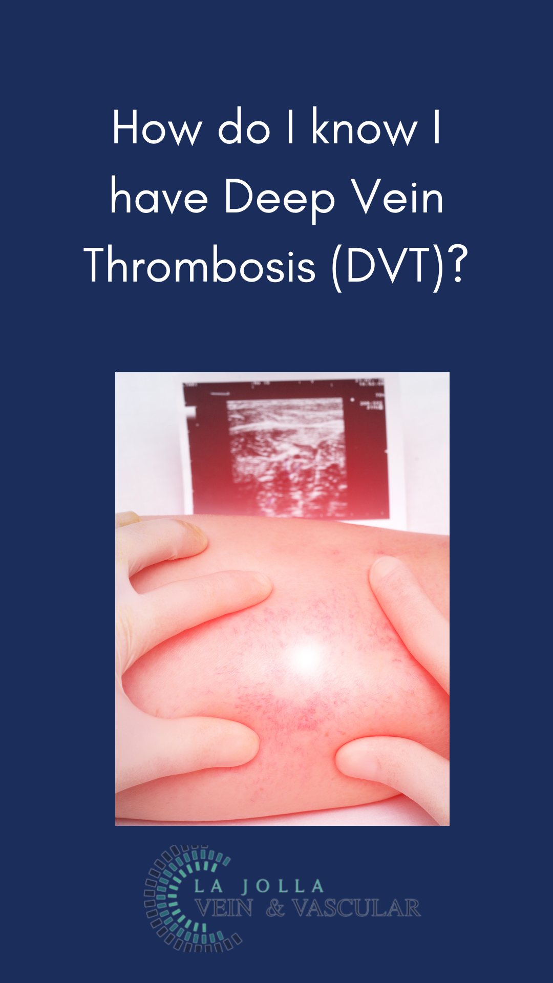 Bunke March Blog Thumbnail-28 How Do You Know If You Have Deep Vein Thrombosis (DVT)?