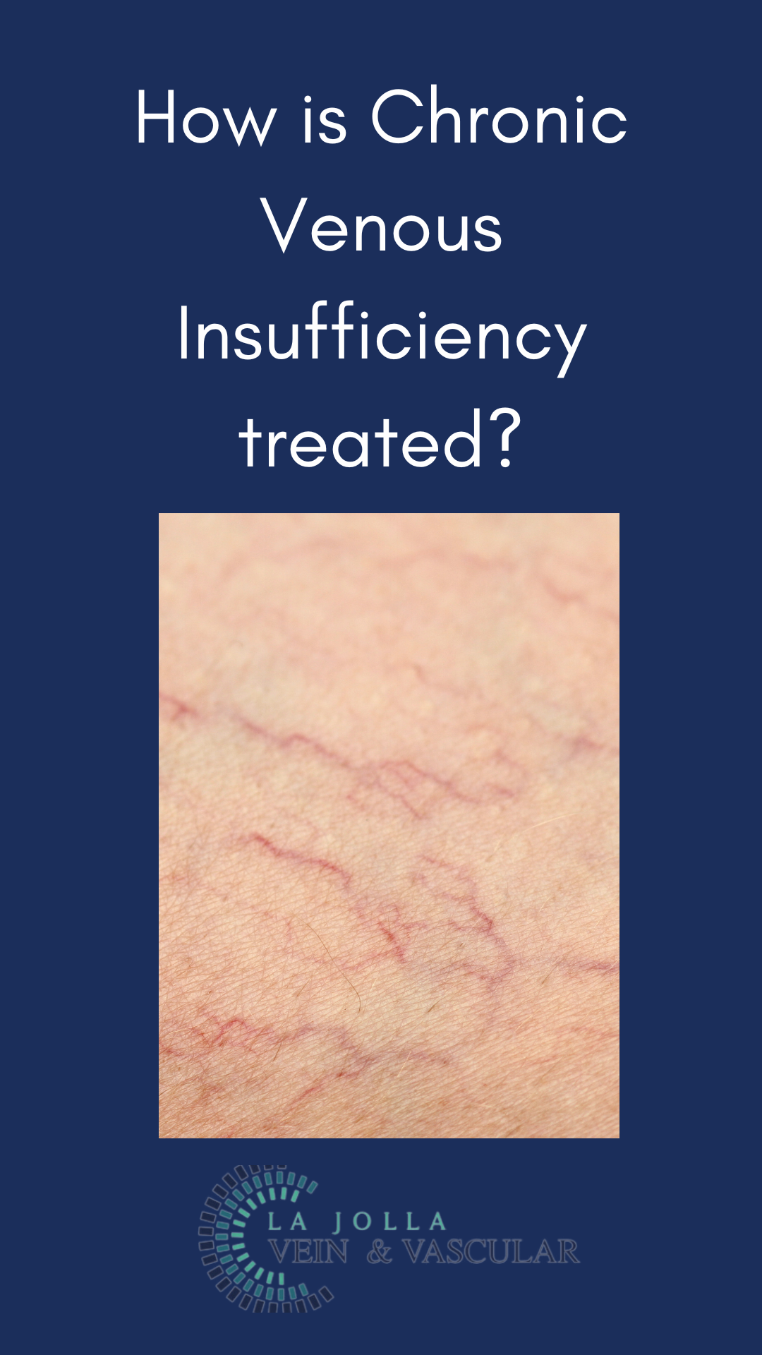 Bunke March Blog Thumbnail-30 Chronic Venous Insufficiency (CVI) Treatment & Solutions