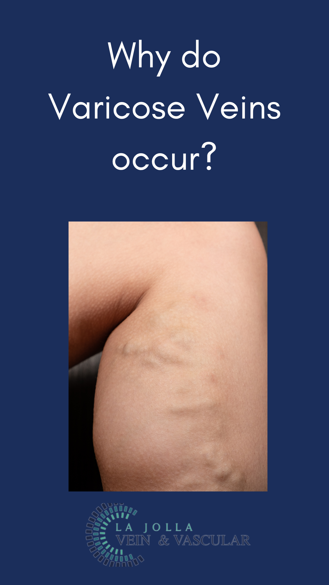 Why Do Varicose Veins Occur? - Understanding Varicose Veins