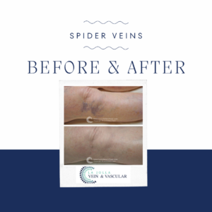 spider veins | What Will My Legs Look Like After Spider Vein Treatment?